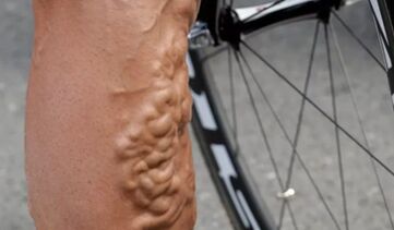 Varices chez un cycliste