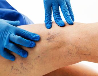 Varices sur les jambes